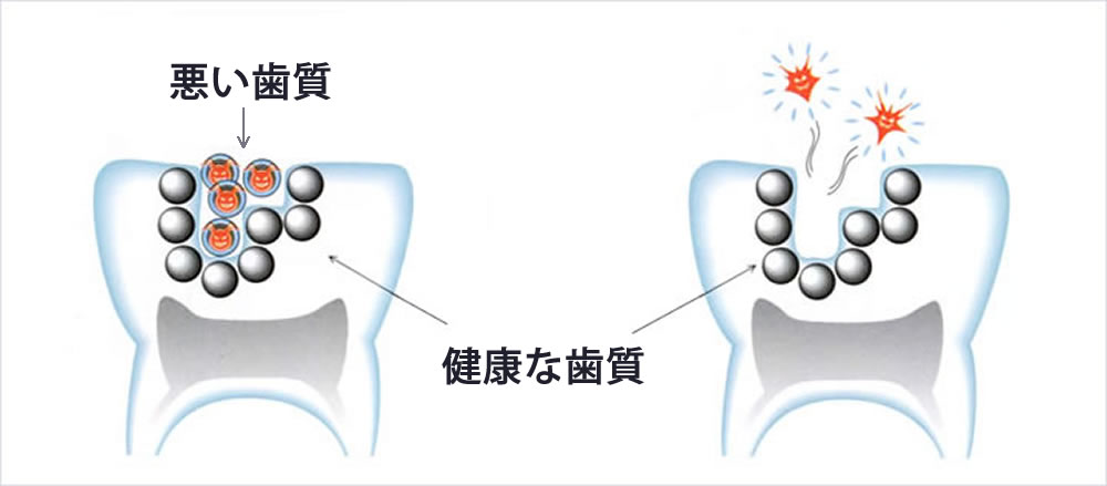 削らない虫歯治療