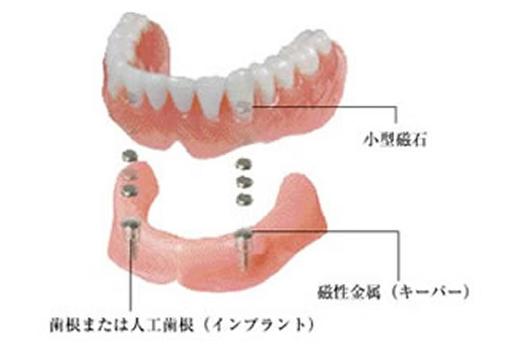 磁性マグネット義歯