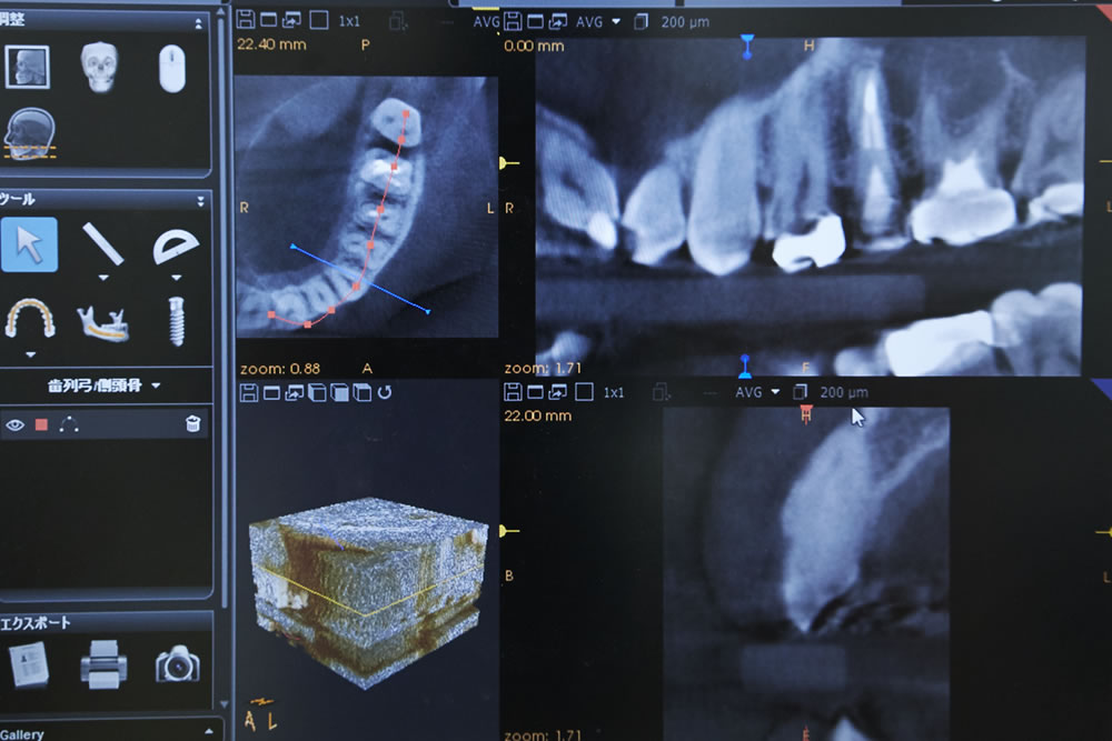 インプラント診断