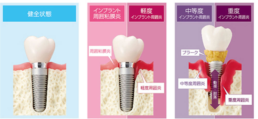 歯周病とインプラント