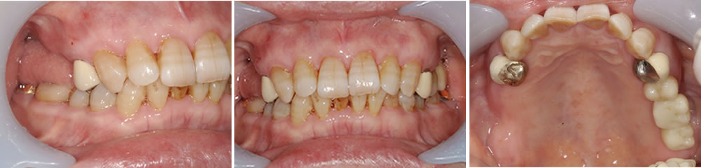 入れ歯治療症例