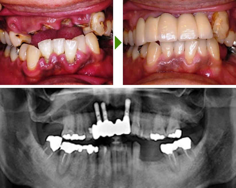 前歯のインプラント症例