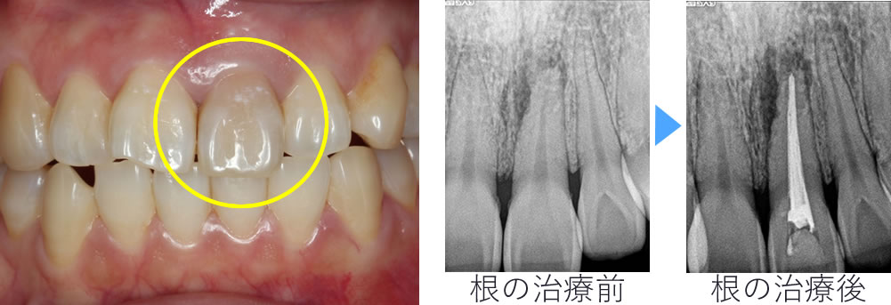 審美歯科治療例1