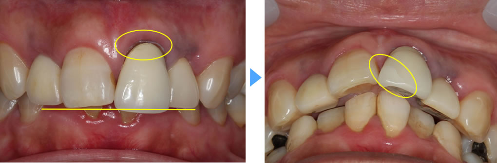 審美歯科治療例4