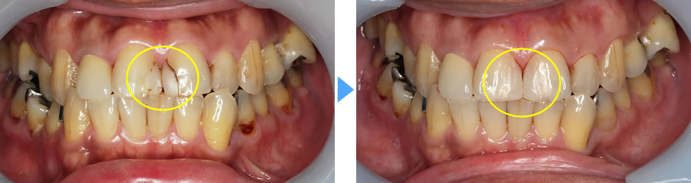 審美歯科治療例4